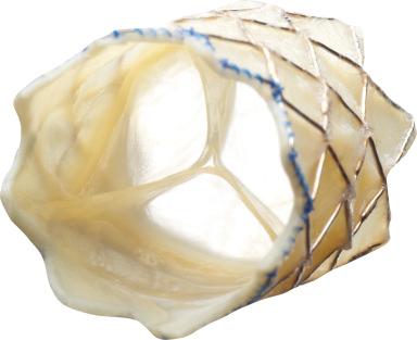 Fig. 56.3, Melody transcatheter pulmonary valve in an oblique view.