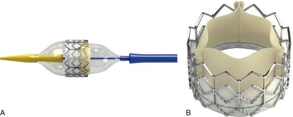 Fig. 56.5, (A) Top view of the Sapien pulmonic transcatheter heart valve. (B) The Retroflex III delivery system.