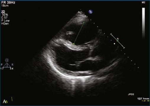 Figure 10-4, Two-dimensional transthoracic echocardiography parasternal long-axis view ( A ) and apical four-chamber view ( B ) of a patient with a saddle pulmonary embolus. Note right ventricular dilation in both views (see Video 10-4).