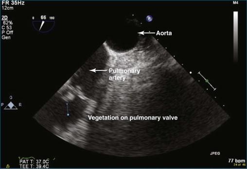 Figure 10-14, Two-dimensional transesophageal echocardiography view at the high esophageal level showing a vegetation on the pulmonary valve. The vegetation is on both the right ventricular outflow tract and pulmonary artery sides of the valve (see Video 10-19).