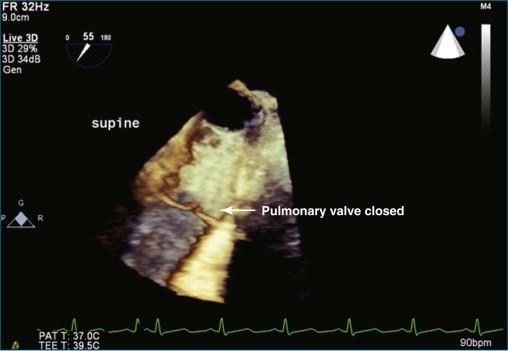 Figure 10-16, Three-dimensional transesophageal echocardiography view at the high esophageal level showing a closed pulmonary valve (see Video 10-16).