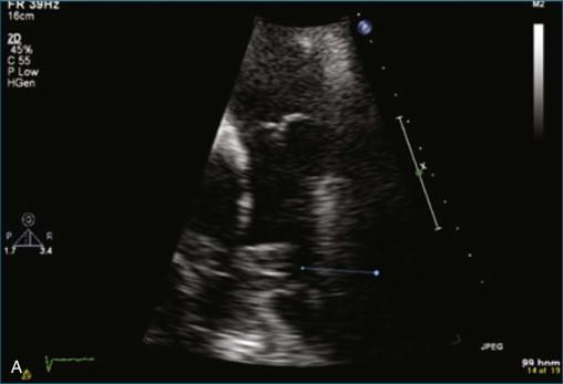 Figure 10-5, Two-dimensional ( A ) and three-dimensional ( B ) parasternal short-axis views showing thrombus ( arrow ) at the bifurcation of the pulmonary artery ( line ) (see Video 10-5).