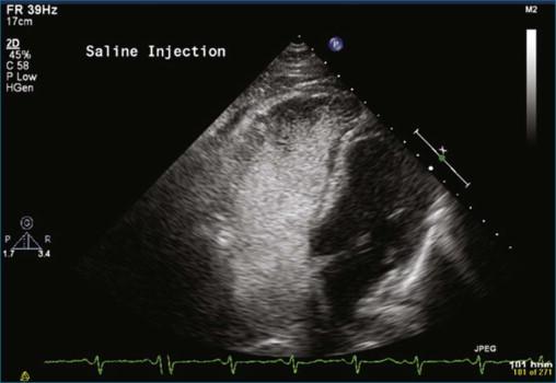 Figure 10-6, Saline contrast study showing a dilated right ventricle (see Videos 10-6 and 10-7).