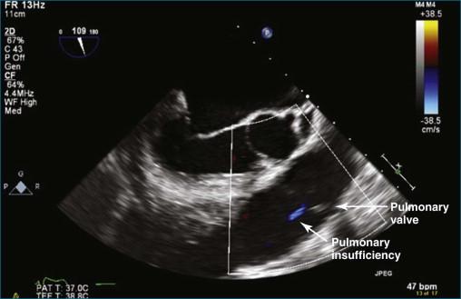 Figure 10-7, Two-dimensional transthoracic echocardiography mid-esophageal view of the pulmonary valve with a mild pulmonary regurgitation color Doppler jet (see Video 10-8).