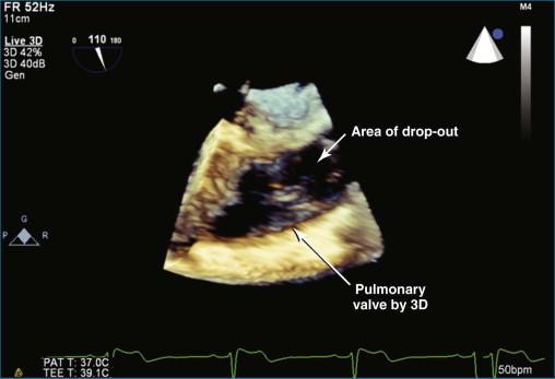 Figure 10-8, Live three-dimensional (3D) transesophageal echocardiography view of the pulmonary valve at the mid-esophageal level. The two main limitations of 3D imaging are shown in this image. First, there are notable echolucent, or “black areas,” of echo dropout, which are a compromise of gain and compress settings that allow visualization of the pulmonary valve. Increasing gain would eliminate the dropout but would add additional echoes covering the pulmonary valve, making it invisible. The second limitation is difficulty viewing structures that are very thin, in this case the pulmonary valve itself. A thicker abnormal pulmonary valve with classic sclerotic changes would be more visible (see Videos 10-9 and 10-10).