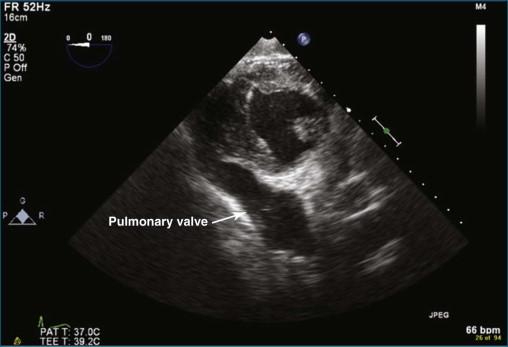 Figure 10-10, Two-dimensional transesophageal echocardiography view of the pulmonary valve from the deep gastric view (see Video 10-11).