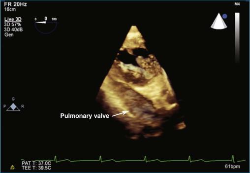 Figure 10-11, Three-dimensional transesophageal echocardiography deep gastric view of the pulmonary valve. Because of its very thin leaflets, the pulmonary valve remains difficult to see (see Video 10-12).