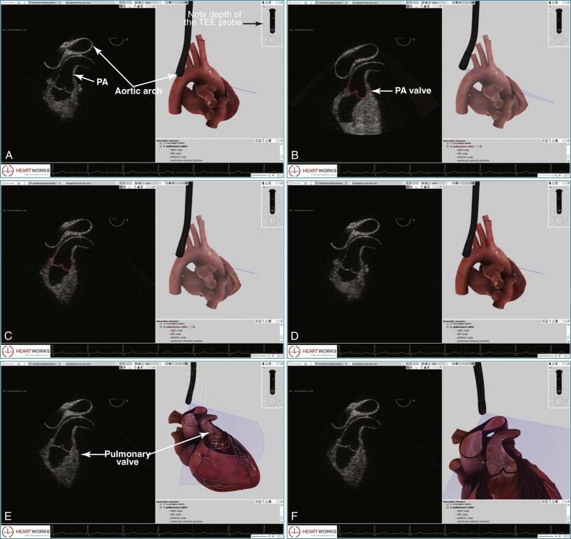 Figure 10-12, A, Placement of the transesophageal echocardiography (TEE) probe for acquisition of the high esophageal view is shown by TEE simulation. B, A similar illustration obtained by TEE simulation with emphasis on the pulmonary valve. The TEE probe is slightly retroflexed relative to the image in A . C, TEE probe position for obtaining the high esophageal view. D, Setup to show a cutaway of the pulmonary valve. E, Similar depth of the TEE probe, with similar 2D image on the left. At right, the pulmonary artery aortic arch has been partially cut away to show the pulmonary valve cusps. F, The position of the TEE probe has not substantially changed. A zoomed view of the aortic arch and pulmonary valve is shown.
