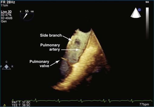 Figure 10-13, Three-dimensional transesophageal echocardiography view of the pulmonary artery, pulmonary valve, and an apparent pulmonary artery side branch. This view was obtained at the high esophageal level at the aortic arch (see Video 10-13).