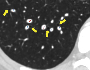 Figure 27.1, Normal right lung base pulmonary vascular anatomy on CT. Pulmonary arteries (blue A) travel in parallel with bronchi (arrows). Pulmonary veins (red V) travel separately from the arteries and bronchi. These anatomic relationships help distinguish arteries from veins when they cannot be followed back to the heart—for example, when there is a potential filling defect on the top slices of an abdominal CT.