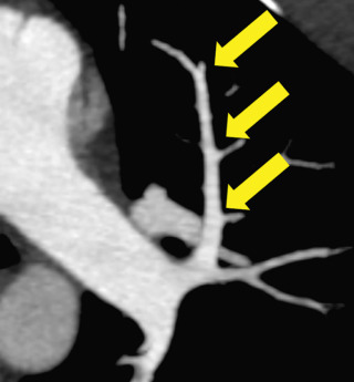 Figure 27.2, Axial maximum intensity projection image of normal left upper lobe pulmonary artery branches. Note how the artery narrows as it branches (arrows) ; emboli commonly lodge at these branch points.