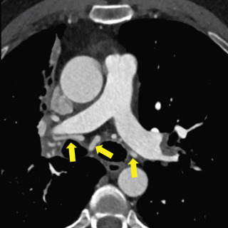 Figure 27.3, Axial CT pulmonary angiography demonstrating dilated, tortuous bronchial arteries (arrows).