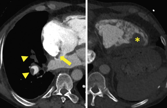 Figure 27.4, Embolus in transit, with clot caught in an interatrial septal aneurysm (arrow) and in the right ventricular apex (asterisk) . In addition to a pulmonary embolism (arrowheads) , this patient suffered a stroke due to an embolism traversing a patent foramen ovale.