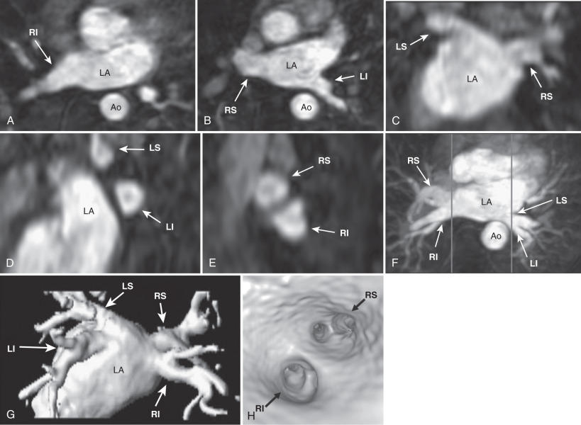 FIG. 42.1, Normal anatomy and quantification of pulmonary vein size. These images show the normal complement of four pulmonary veins, along with left atrium (LA) and descending aorta (Ao). The right inferior (RI), right superior (RS), and left inferior (LI) pulmonary veins are shown in the axial plane (A and B). The left superior (LS) and right superior pulmonary veins are shown in the coronal plane from the posterior-anterior orientation (C). The left-sided (D) and right-sided (E) pulmonary veins are shown in the sagittal plane (anterior to the left). All of the pulmonary veins are shown in the axial maximal intensity projection (F) and posterior-anterior volume-rendered (G) images. The ostia of the right-sided pulmonary veins can be identified in the endovascular reconstruction (H).