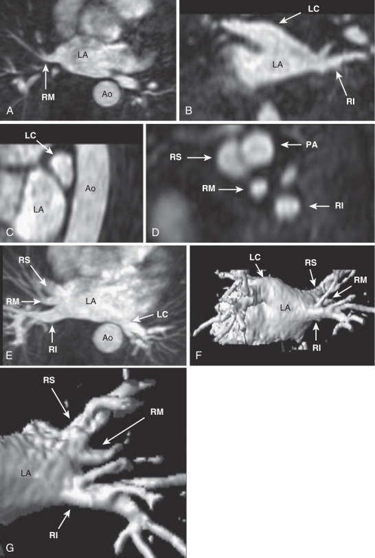 FIG. 42.2, Variant pulmonary venous anatomy. These images were obtained from a patient with right middle and left common pulmonary veins. The right middle (RM) pulmonary vein is shown in the axial plane (A). The left common (LC) pulmonary vein is shown in the coronal plane from the posterior-anterior orientation (B). The single left common (C) and all three right pulmonary veins (D) are shown in the sagittal plane (anterior to the left) along with the pulmonary artery (PA) immediately adjacent to the right superior pulmonary vein. All of the pulmonary veins are shown in the axial maximal intensity projection (E) and posterior-anterior volume-rendered (F) images. The aorta has been removed from the volume-rendered image. The right middle pulmonary vein is obscured by the right inferior pulmonary vein and is best seen with cranial angulation (G). It is frequently necessary to manipulate the point of view to see all of the pulmonary veins. Ao, Aorta; LA, left atrium; RI, right inferior pulmonary vein; RS, right superior pulmonary vein.