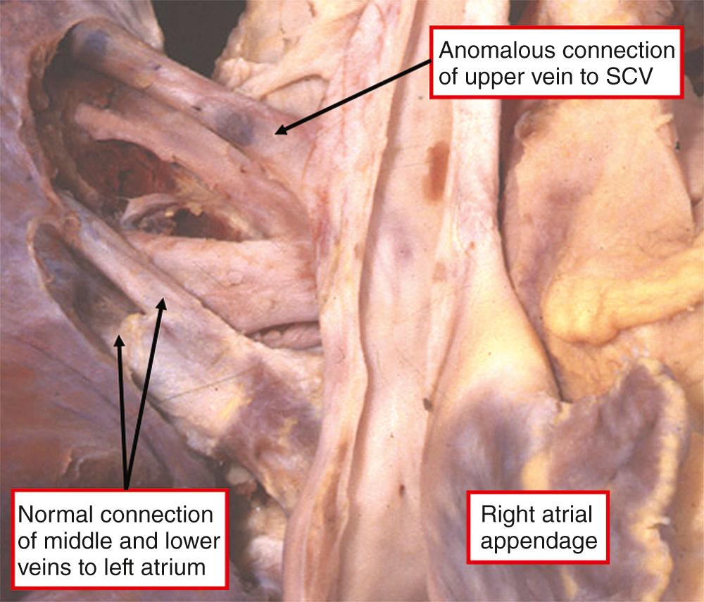 Fig. 28.1, Anomalous connection of the right upper pulmonary vein to the superior caval vein (SCV), which was discovered as an incidental finding in an otherwise normal autopsy.