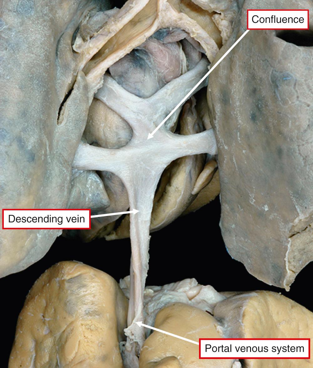 Fig. 28.11, Infradiaphragmatic and infracardiac totally anomalous pulmonary venous connection. Having passed into the abdomen, the venous confluence terminates in the portal venous system.