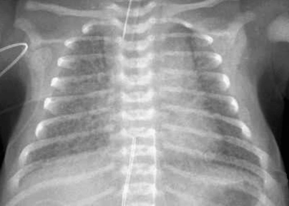 Fig. 28.12, Chest radiograph typical of obstructed totally anomalous pulmonary venous connection showing a ground-glass appearance in both lung fields and a small cardiac shadow.