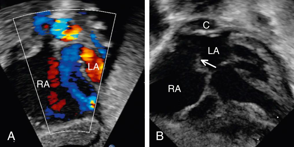Fig. 28.13, Echocardiographic images displaying key findings that should raise the suspicion for totally anomalous pulmonary venous connection. (A) This image, taken in a subcostal short-axis plane, reveals exclusively right-to-left flow at the atrial septum. When this finding is present, one must definitively identify the presence or absence of pulmonary venous connections to the left atrium. (B) This image, taken in the subcostal long-axis plane, shows a structure posterior to the left atrium. This finding should raise suspicion for a pulmonary venous confluence, which can be differentiated from a pulmonary artery using color and spectral Doppler. In addition, the flap valve of the oval foramen is pushed rightward (arrow) , consistent with right-to-left flow at the atrial septum. C, Confluence; LA, left atrium; RA, right atrium.