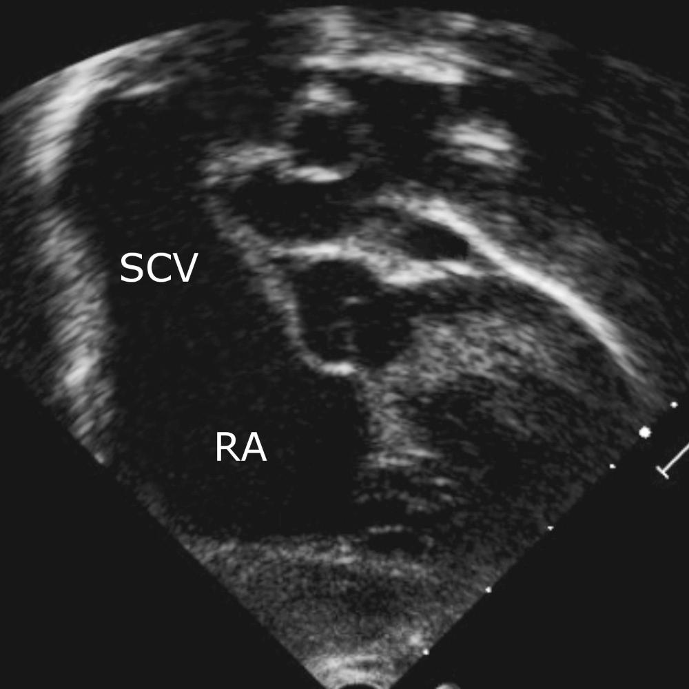 Fig. 28.14, An image, taken from the subcostal long-axis view angled posteriorly, showing the severely dilated superior caval vein (SCV) emptying into the right atrium (RA), suggesting the presence of an anomalous pulmonary venous connection. Further investigation revealed a totally anomalous pulmonary venous connection to the left brachiocephalic vein.