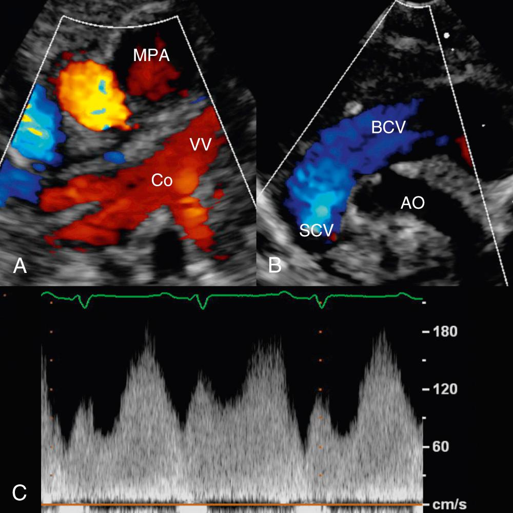 Fig. 28.15, Echocardiographic images in a patient with the supracardiac form of totally anomalous pulmonary venous connection. (A) A suprasternal notch image displaying pulmonary venous drainage to a confluence (Co), with drainage superiorly via a vertical vein (VV) to the left brachiocephalic vein (not shown). The main pulmonary artery (MPA) is dilated, which is a common finding in patients with anomalous pulmonary venous drainage. (B) A suprasternal notch image revealing a dilated brachiocephalic vein (BCV) and superior caval vein (SCV). Note that these veins are much larger than the normal-sized aorta (AO), which should raise suspicion for a supracardiac totally anomalous pulmonary venous connection. (C) Pulsed-wave Doppler analysis in the vertical vein revealing phasic low-velocity flow, which is the typical flow pattern in the absence of obstruction.