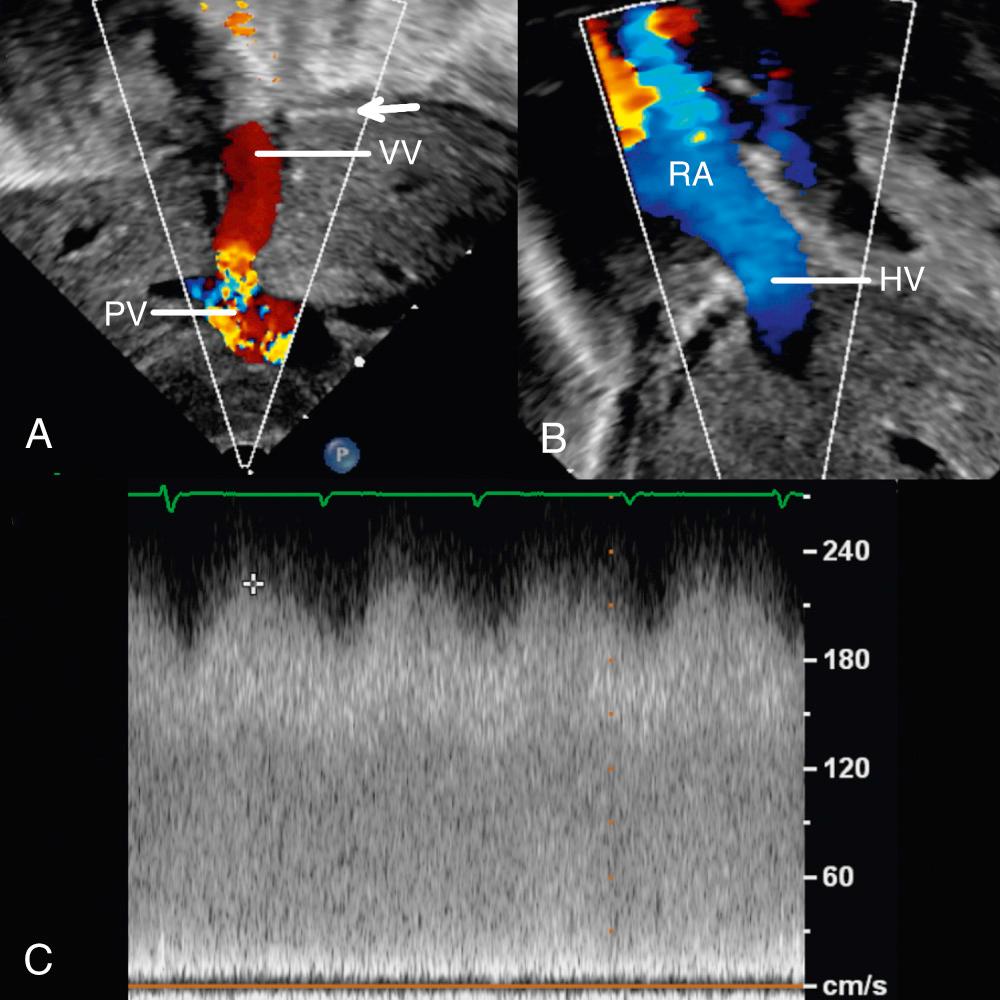 Fig. 28.16, Echocardiographic images taken in a patient with infracardiac totally anomalous pulmonary venous connection to the portal vein. (A) Subcostal long-axis view shows the vertical vein (VV) crossing the diaphragm (arrow) and connecting with the portal vein (PV), with turbulence by color Doppler. (B) Subcostal short-axis view shows a dilated hepatic vein (HV) entering the right atrium (RA). (C) Spectral Doppler measurement taken in the vertical vein. Note the high velocity with decreased phasicity compared with Fig. 28.15 , consistent with venous obstruction.