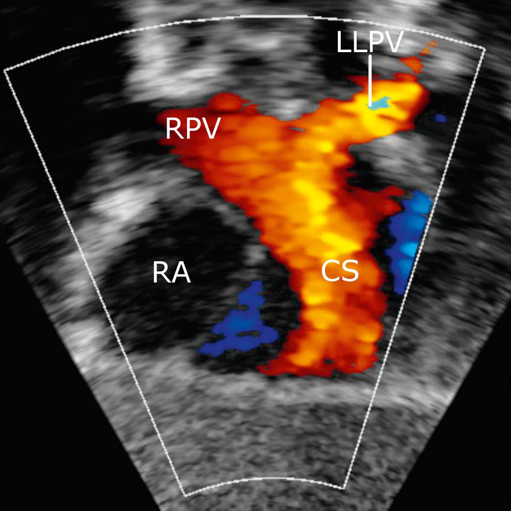 Fig. 28.17, Subcostal long-axis view in a patient with a totally anomalous pulmonary venous connection to the coronary sinus. The probe has swept inferior to the left atrium to reveal the right pulmonary veins (RPV) and left lower pulmonary vein (LLPV) draining into a dilated coronary sinus (CS), which subsequently drains into the right atrium (RA). The left upper pulmonary vein cannot be seen in this image, but it also drained into the coronary sinus ( Videos 28.4 and 28.5 ).