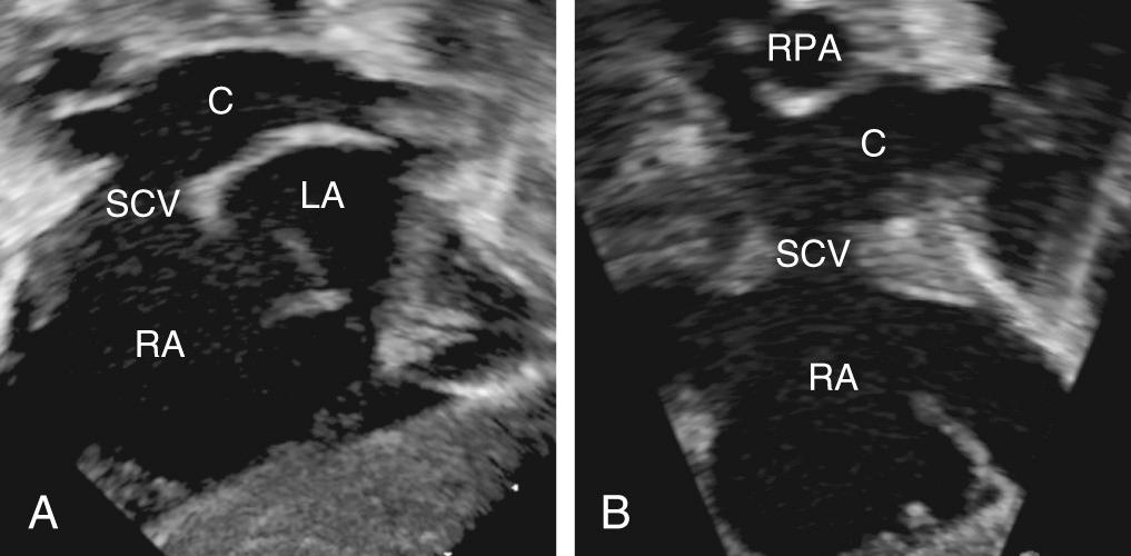 Fig. 28.18, Echocardiographic images taken in a patient with a supracardiac totally anomalous pulmonary venous connection with drainage to the superior caval vein. (A) An image in the subcostal long-axis plane reveals a large pulmonary venous confluence (C) posterior to the left atrium (LA), with a direct connection to the superior caval vein (SCV). (B) An image in the subcostal short-axis plane also displays the pulmonary venous confluence (C) that connects directly to the posterior wall of the SCV inferior to the right pulmonary artery (RPA) ( Video 28.6 ). RA, Right atrium.