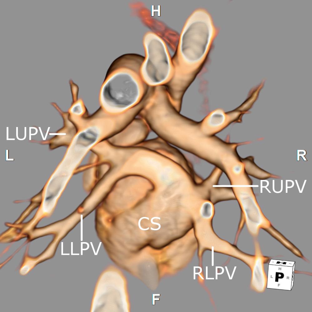 Fig. 28.19, Three-dimensional reconstruction of a computed tomographic angiogram viewed from a posterior perspective. In this patient with a cardiac form of totally anomalous pulmonary venous connection, all the pulmonary veins are seen entering the coronary sinus (CS). Note that the left upper and left lower pulmonary veins (LUPV and LLPV) join to form a common left pulmonary vein, which is a frequent finding even in normal hearts. RLPV , Right lower pulmonary vein; RUPV , right upper pulmonary vein. F, Feet; H, head; L, left; R, right.