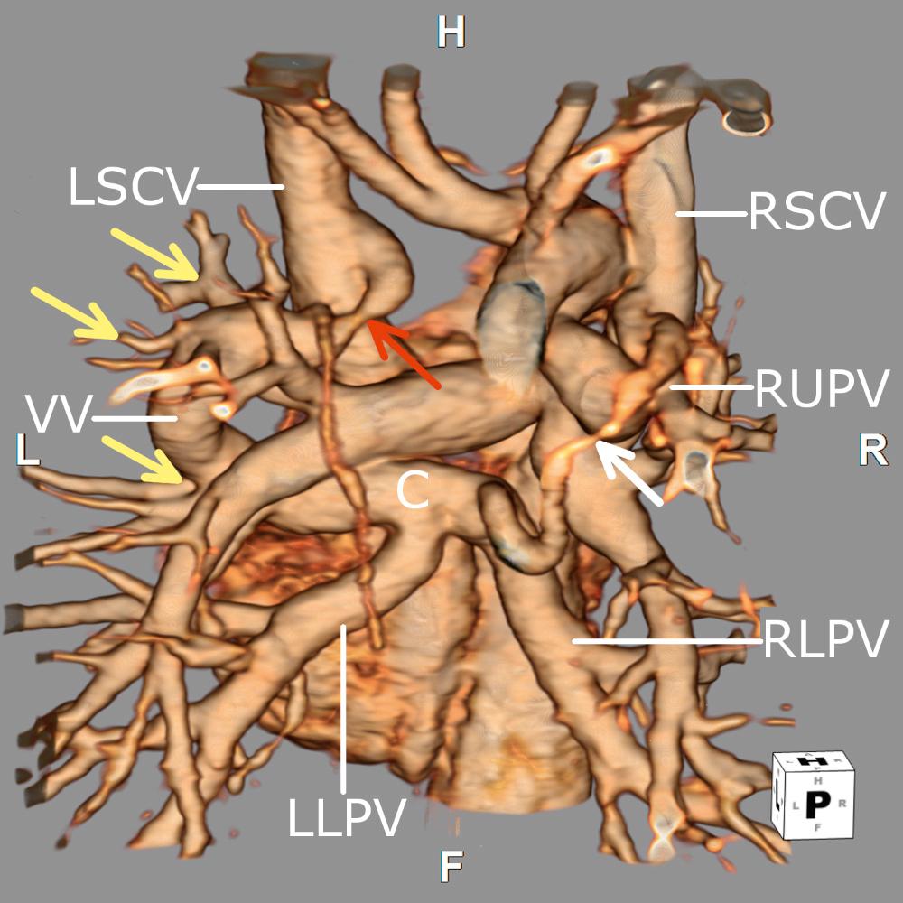 Fig. 28.20, Three-dimensional reconstruction of a computed tomographic angiogram reveals the complex pulmonary venous connections in a patient with a mixed totally anomalous pulmonary venous connection. The right and left lower pulmonary veins (RLPV and LLPV) connect to a horizontal confluence (C), which leads into a vertical vein (VV). Pulmonary venous drainage from the left upper lung empties via multiple separate veins (yellow arrows) as the vertical vein ascends. The vertical vein dives underneath the left azygos vein, resulting in stenosis (red arrow) before joining the rightward aspect of the left superior caval vein (LSCV). The right upper pulmonary vein (RUPV) connects with the leftward aspect of the right superior caval vein (RSCV). There is also a small stenotic vessel (white arrow) connecting the rightward aspect of the confluence to the right azygos vein, which courses superiorly over the right upper pulmonary vein to connect with the right superior caval vein. This image highlights the utility of computed tomography angiography in evaluating complex pulmonary venous connections ( Video 28.7 ). F, Feet; H, head; L, left; R, right.