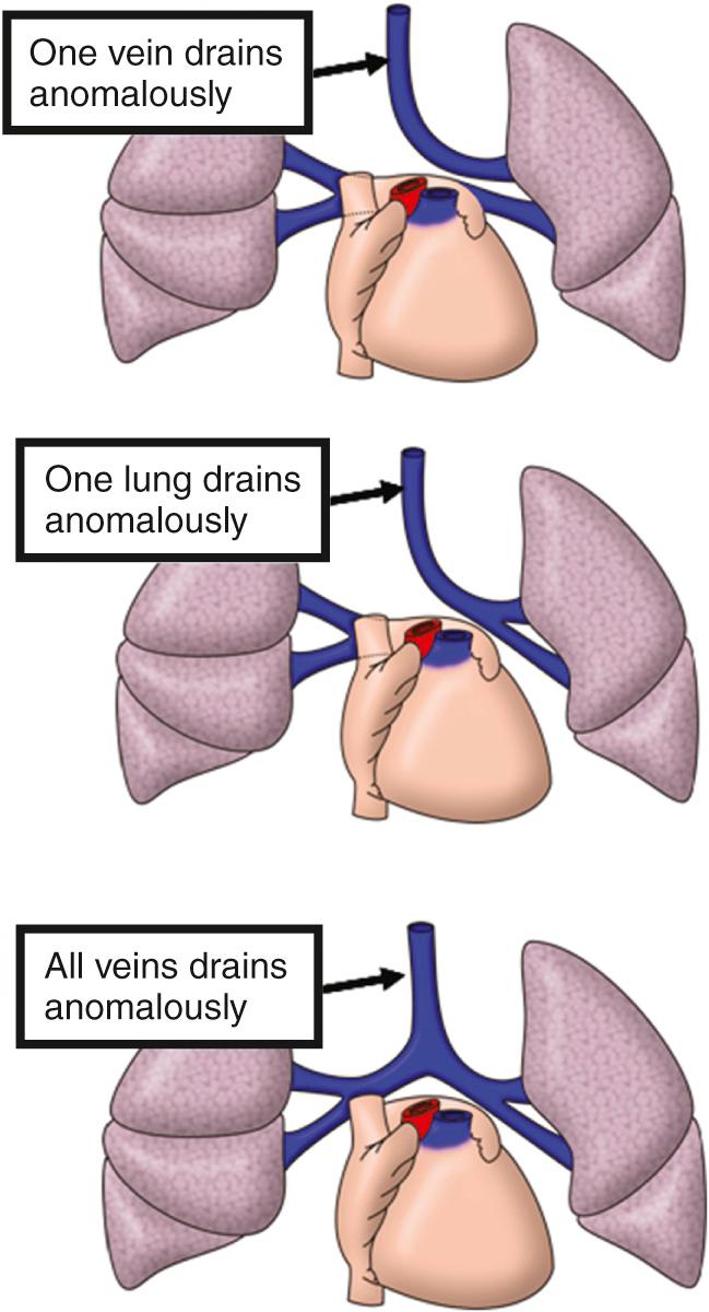 Fig. 28.2, Possibilities for anomalous connection of the pulmonary veins.