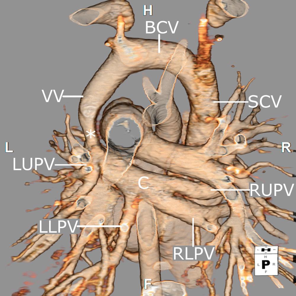 Fig. 28.21, Three-dimensional reconstruction of a computed tomographic angiogram viewed from a posterior perspective from a patient with a supracardiac form of totally anomalous pulmonary venous connection. All four pulmonary veins can be seen entering a horizontal confluence (C), which drains via a vertical vein (VV) into the left braciocephalic vein (BCV). Note the area of stenosis (asterisk) as the confluence joins with the vertical vein, resulting in obstruction. LLPV , Left lower pulmonary vein; LUPV , left upper pulmonary vein; RLPV , right lower pulmonary vein; RUPV , right upper pulmonary vein; SCV , superior caval vein. F, Feet; H, head; L, left; R, right.