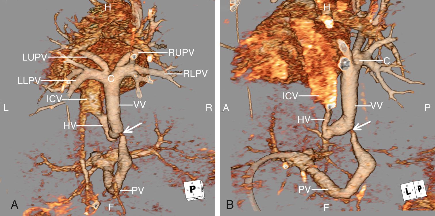 Fig. 28.22, Three-dimensional reconstruction of a computed tomographic angiogram obtained from a patient with the infracardiac form of totally anomalous pulmonary venous connection. Images are viewed from posterior (A) and leftward (B) perspectives, revealing four pulmonary veins entering a small confluence (C). A vertical vein (VV) drains inferiorly through the diaphragm, with connections to a hepatic vein (HV) and the portal vein (PV). There is severe stenosis of the vertical vein (arrow) inferior to the connection with the hepatic vein. ICV , Inferior caval vein; LLPV , left lower pulmonary vein; LUPV , left upper pulmonary vein; RLPV , right lower pulmonary vein; RUPV , right upper pulmonary vein. F, Feet; H, head; L, left; R, right.