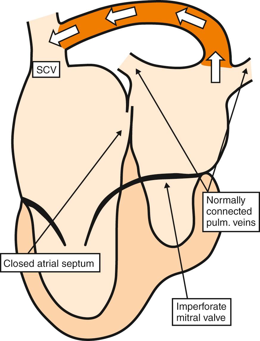 Fig. 28.3, Example of totally anomalous pulmonary venous drainage in the setting of normally connected pulmonary veins, in this instance because a so-called levoatrial cardinal vein joins the left atrium to the superior caval vein (SCV) with mitral atresia and an intact atrial septum.