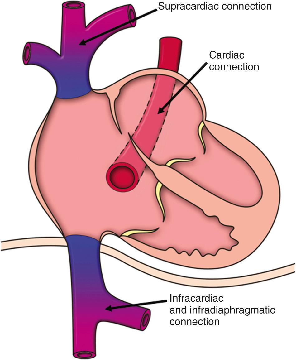 Fig. 28.4, Different sites of anomalous pulmonary venous connection.