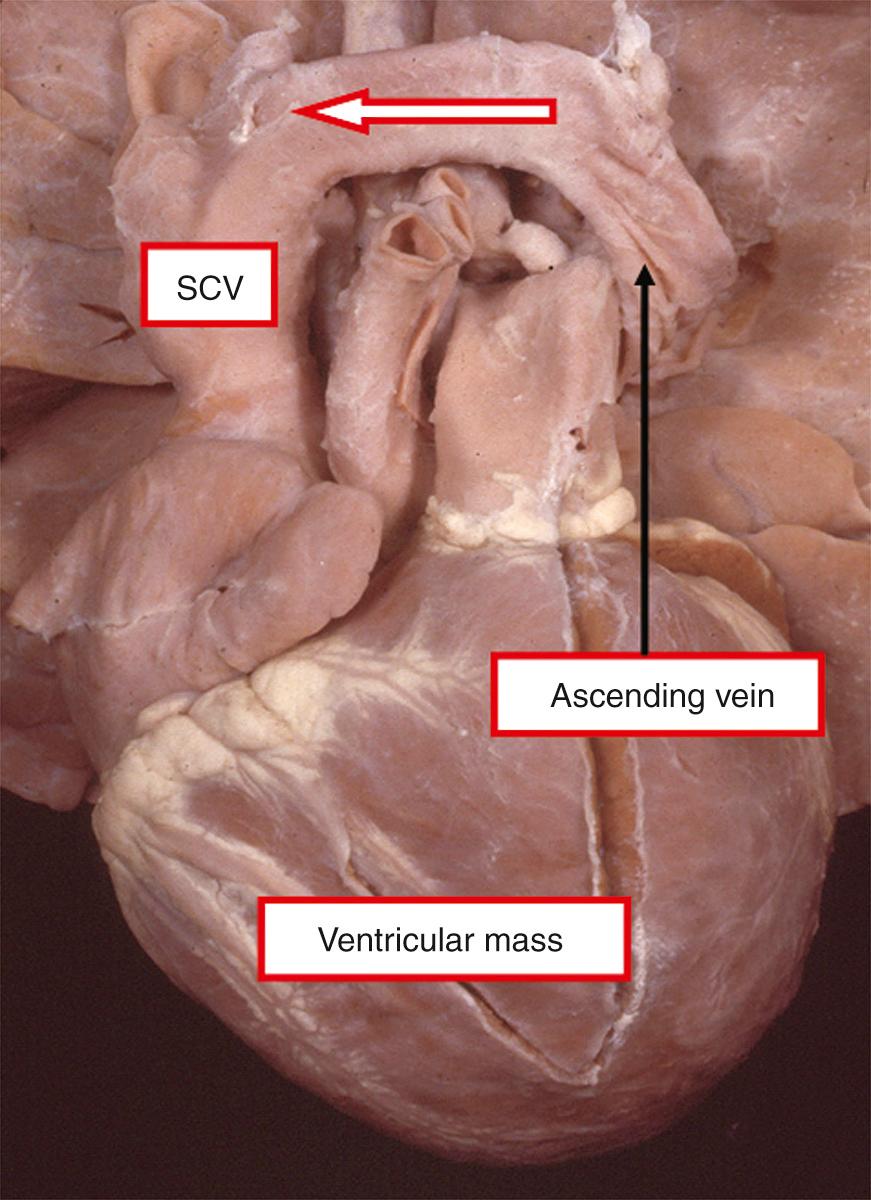 Fig. 28.5, Typical “snowman” pattern of supracardiac totally anomalous pulmonary venous connection to the superior caval vein (SCV). The anomalous venous pathway forms the head of the snowman, while the ventricular mass accounts for the body.