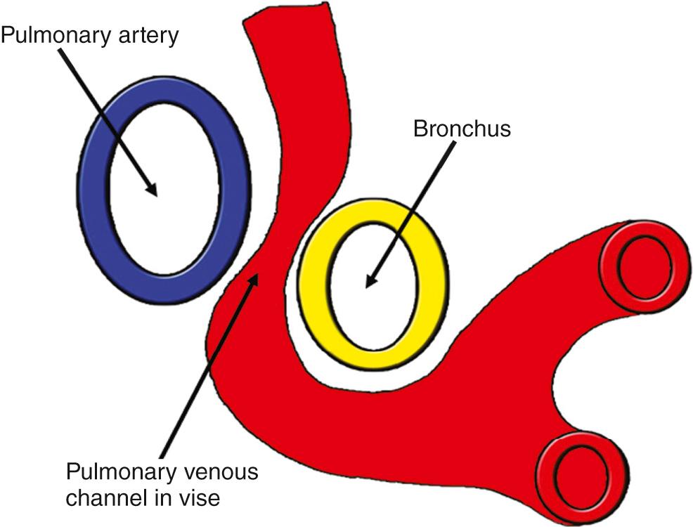 Fig. 28.6, Bronchopulmonary vise, which produces obstruction with supracardiac connections.