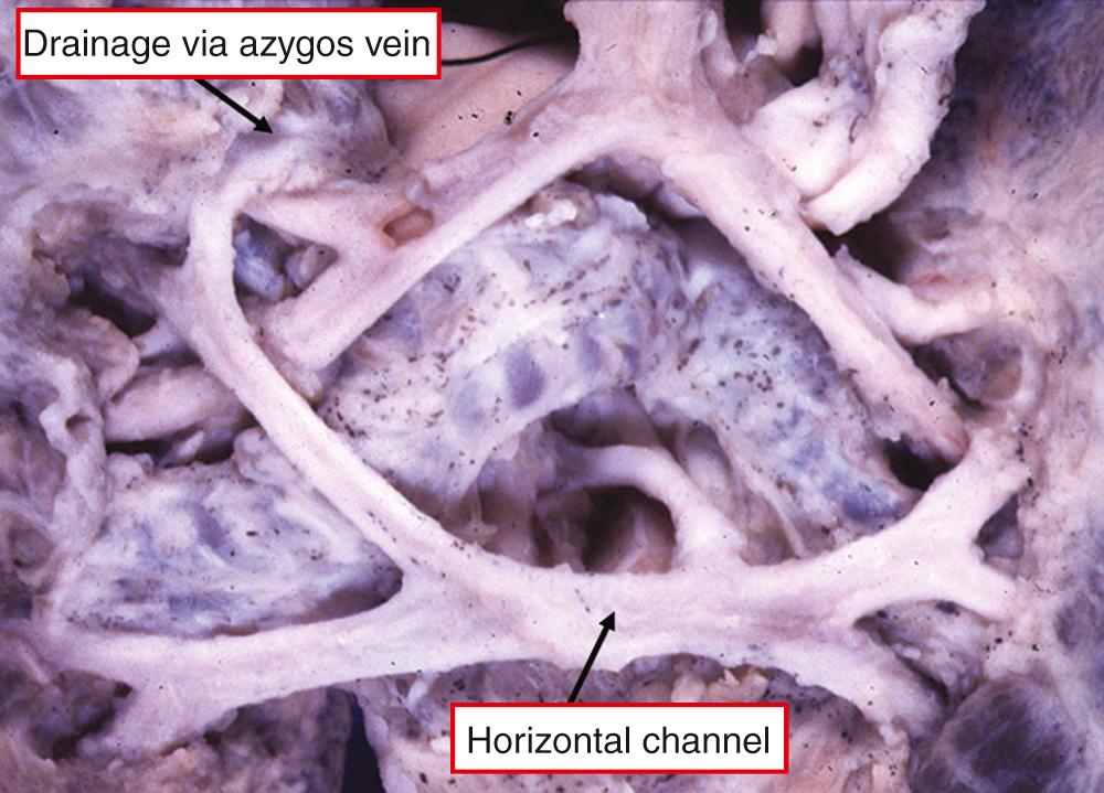 Fig. 28.7, Specimen from a patient with isomeric right atrial appendages showing the horizontal vein passing from left to right and ascending in the right paravertebral gutter, draining in supracardiac fashion through the azygos vein.