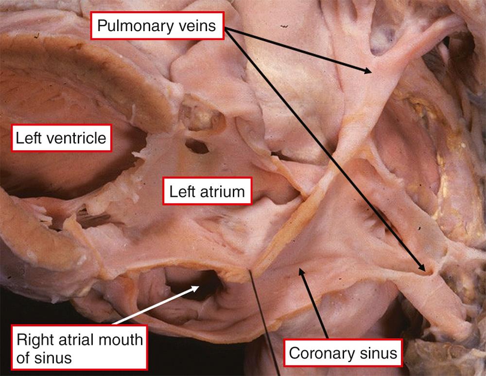 Fig. 28.8, Totally anomalous pulmonary venous connection through the coronary sinus to the right atrium. The heart is photographed from behind and from the left side. If the walls separating the cavity of the sinus from the left atrium are removed, the anomaly can be corrected simply by closing the right atrial mouth of the coronary sinus.