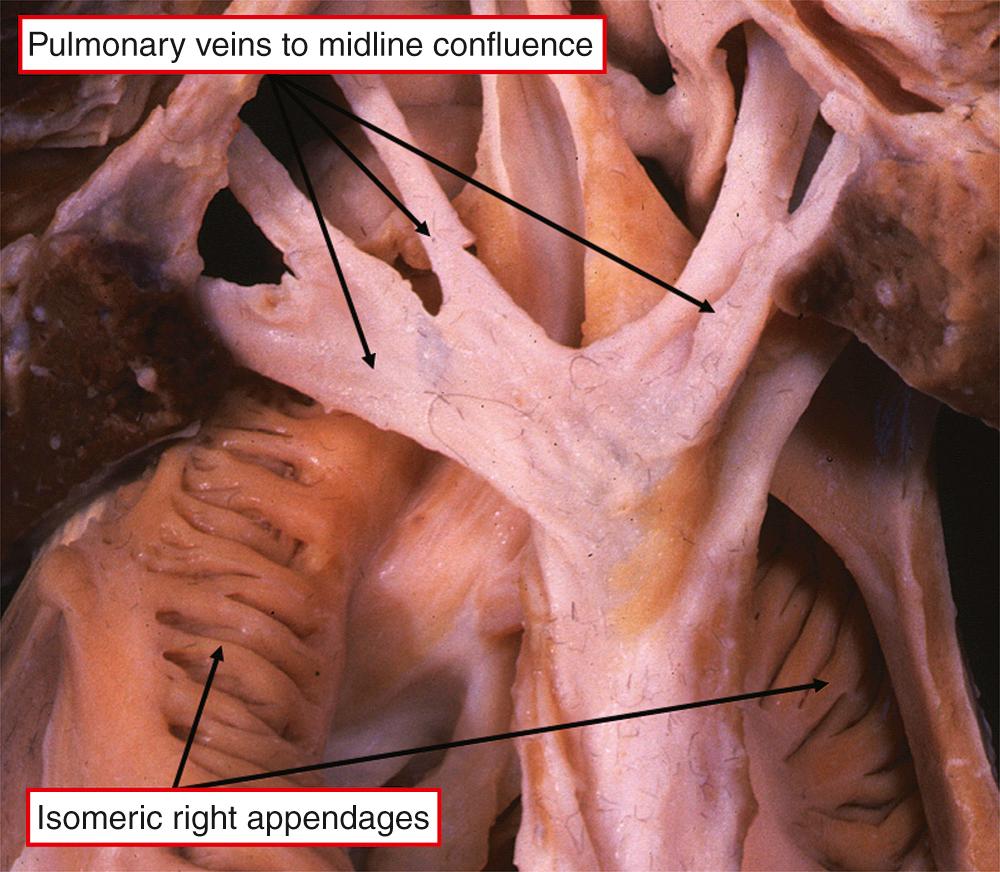 Fig. 28.9, Heart from a patient with isomeric atrial appendages showing all the pulmonary veins draining through a midline fibrous confluence.