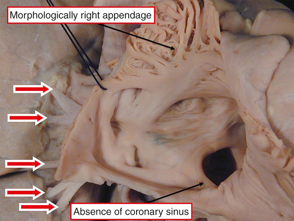 Fig. 28.10, Heart from a patient with isomeric right atrial appendages. Note the absence of the coronary sinus. All pulmonary veins (arrows) connect directly but separately to the right-sided atrium.