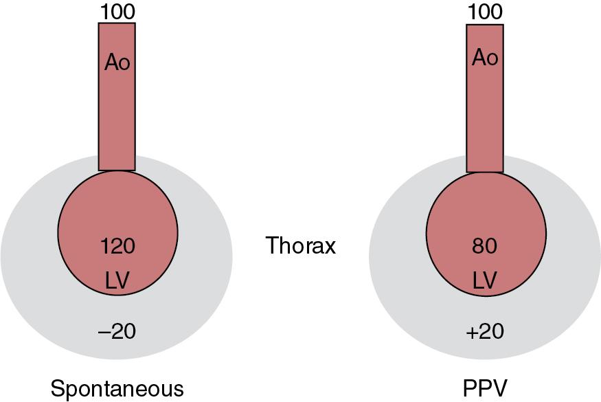 Fig. 9.1, Effects of intrathoracic pressure on left ventricular (LV) afterload.