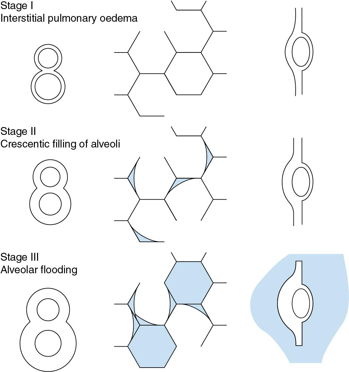 • Fig. 29.2, Schematic diagram of the stages in the development of pulmonary oedema. On the left is shown the development of the cuff of distended lymphatics around the branches of the bronchi and pulmonary arteries. In the middle is the appearance of the alveoli by light microscopy (fixed in inflation). On the right is the appearance of the pulmonary capillaries by electron microscopy. The active side of the capillary is to the right. See text for details.