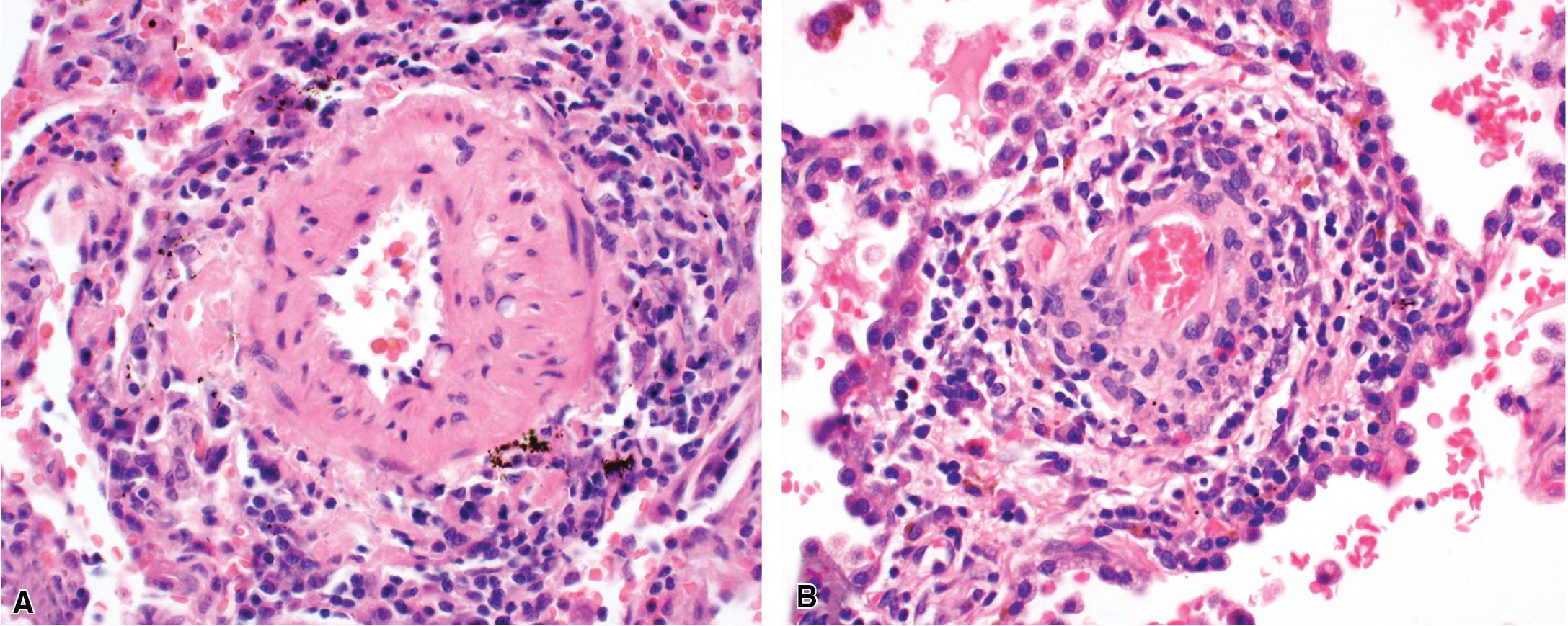 Figure 11.1, Vascular inflammation versus vasculitis. (A) Vessel-associated inflammation. (B) True vasculitis. Note the disruption of the media by inflammatory cells in true vasculitis.