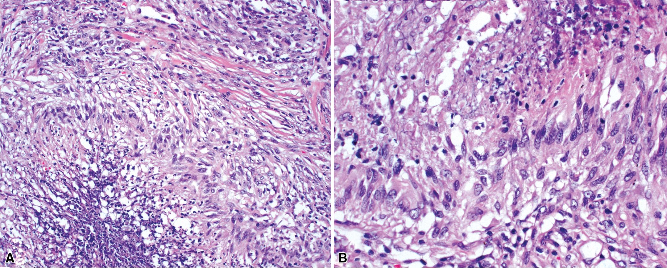 Figure 11.11, Granulomatosis with polyangiitis (GPA): granulomatous inflammation. (A) The granulomatous inflammation of GPA generally has a palisaded configuration. (B) A closer view of palisaded histiocytes can be seen bordering basophilic necrosis with nuclear debris.