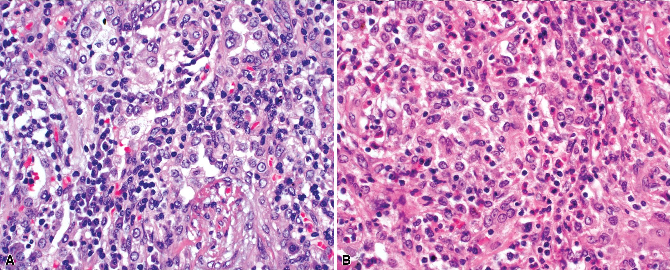 Figure 11.12, Granulomatosis with polyangiitis (GPA): associated inflammation. Inflammatory infiltrate of GPA is generally mixed with plasma cells, lymphocytes (A), and a variable number of eosinophils (B).