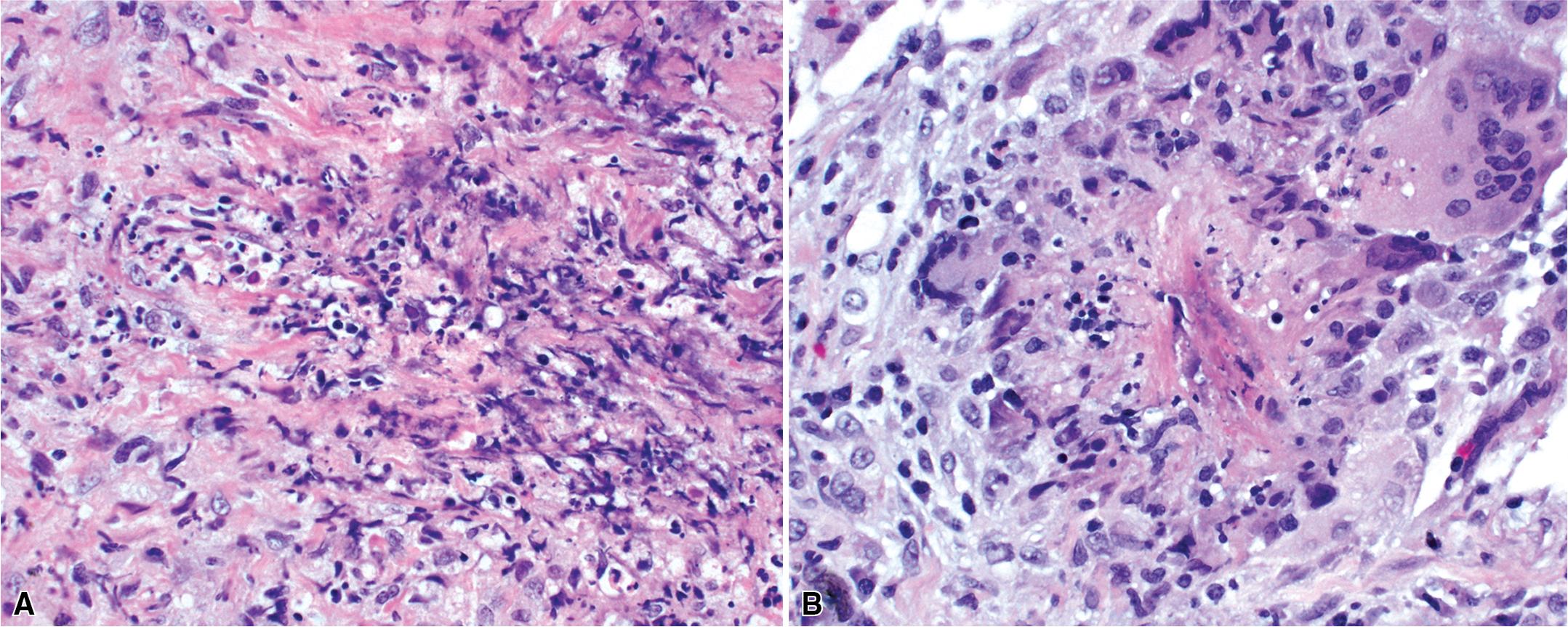 Figure 11.13, Granulomatosis with polyangiitis (GPA): collagen necrosis. Collagen necrosis is thought to be the primary pathologic event in GPA. Zones of collagen necrosis can be vague (A) or discrete and associated with giant cells and granulomatosis inflammation (B).