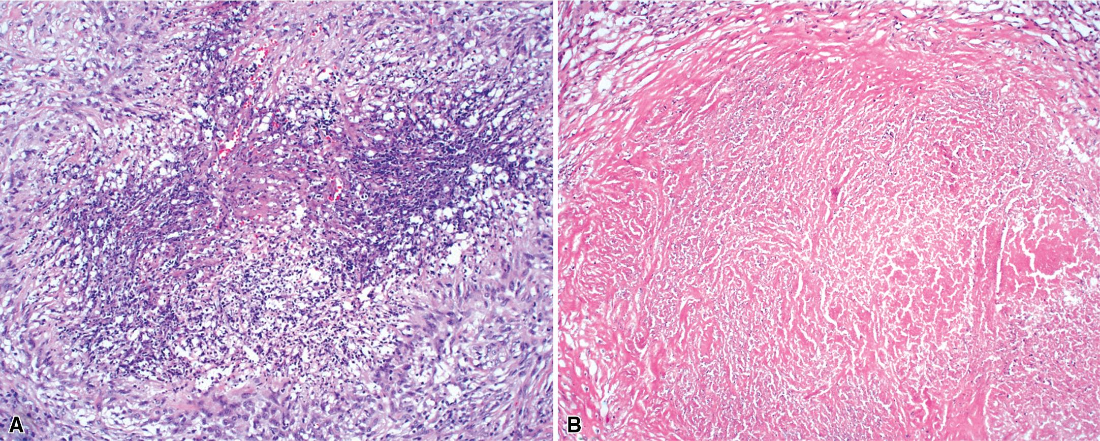 Figure 11.14, Granulomatosis with polyangiitis (GPA): basophilic necrosis. (A) The necrosis of GPA is basophilic owing to an abundance of nuclear debris. (B) In necrotizing granulomatous infection, the necrosis typically has an eosinophilic appearance with some preservation of structure in areas of necrosis (this background structure visible within necrosis often is absent in GPA).