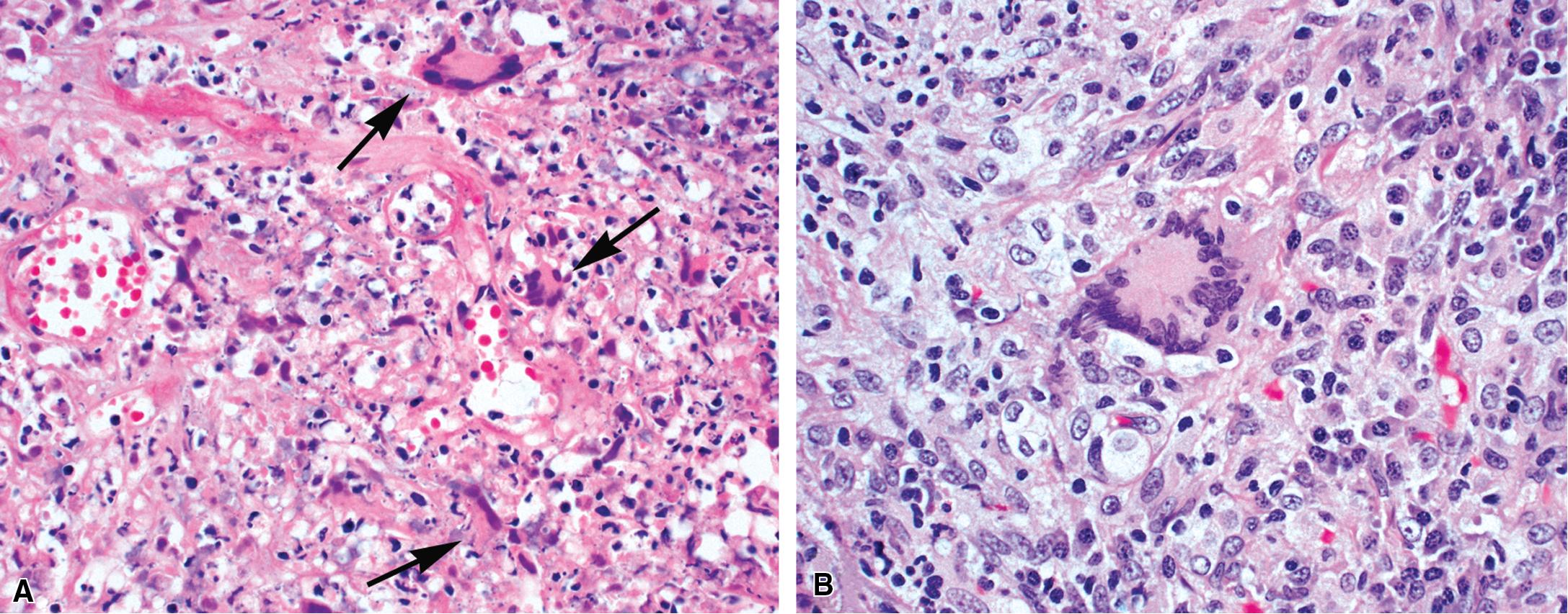 Figure 11.15, Granulomatosis with polyangiitis: giant cells. (A) The characteristic giant cells (arrows) have smudged basophilic nuclei, often marginated at the periphery of the cell. (B) A typical multinucleate giant cell is evident at the periphery of necrosis (upper left) .