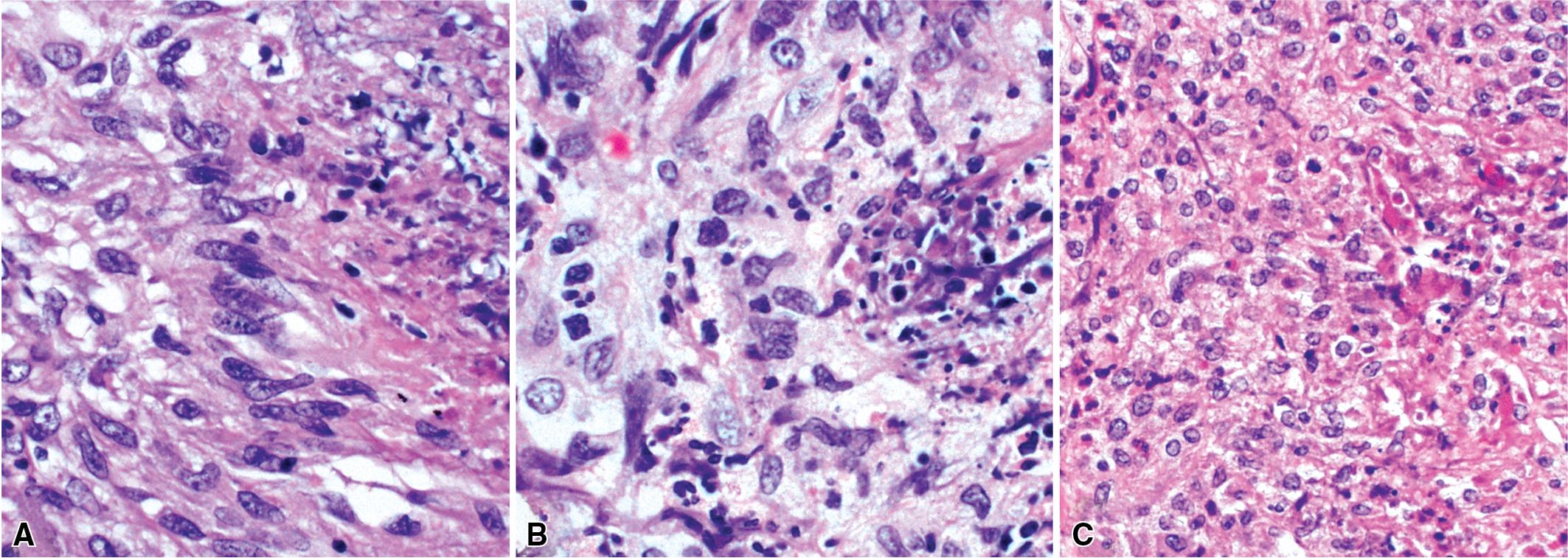 Figure 11.16, Granulomatosis with polyangiitis: types of granulomatous inflammation. Three examples of granulomatous inflammation at the periphery of necrosis: palisaded histiocytes (A); epithelioid histiocytes with little organization (B); plump eosinophilic histiocytes (C).